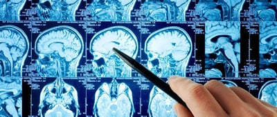 La diagnosi precoce in neurologia: la chiave per bloccare la malattia prima che causi disabilità